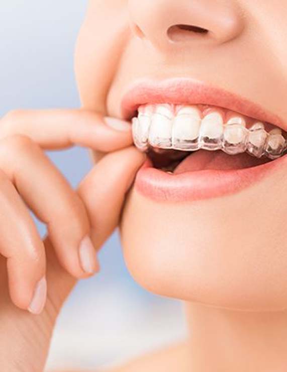 2f4f8a7ae9ec58adb4c89b8b8aca75f4.white-woman-puts-invisalign-into-mouth